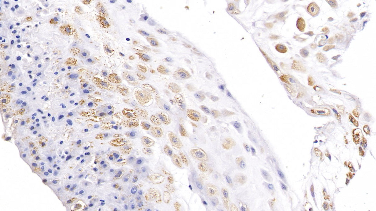 DAB staining on IHC-P; Samples: Human Placenta Tissue;  Primary Ab: 10µg/ml Rabbit Anti-Human NT5C2 Antibody Second Ab: 2µg/mL HRP-Linked Caprine Anti-Rabbit IgG Polyclonal Antibody 